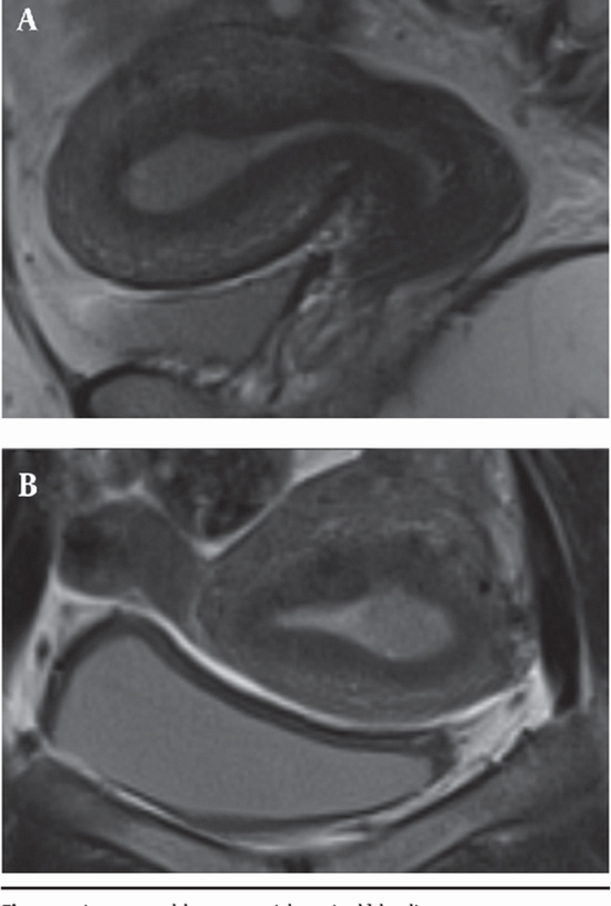 Assessment of the Depth of Myometrial Invasion and Cervical Involvement {faces}